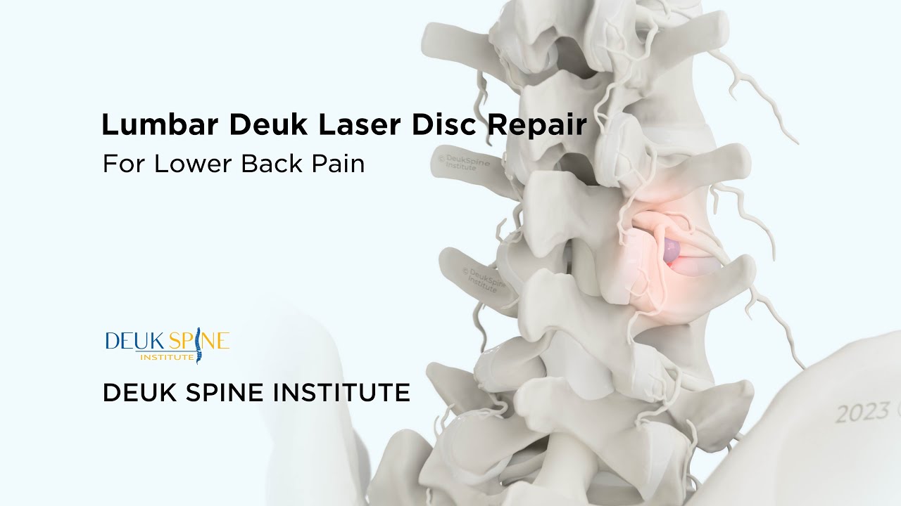 Lumbar Deuk Laser Disc Repair (DLDR) for Discogenic Back Pain - (3D Animation)