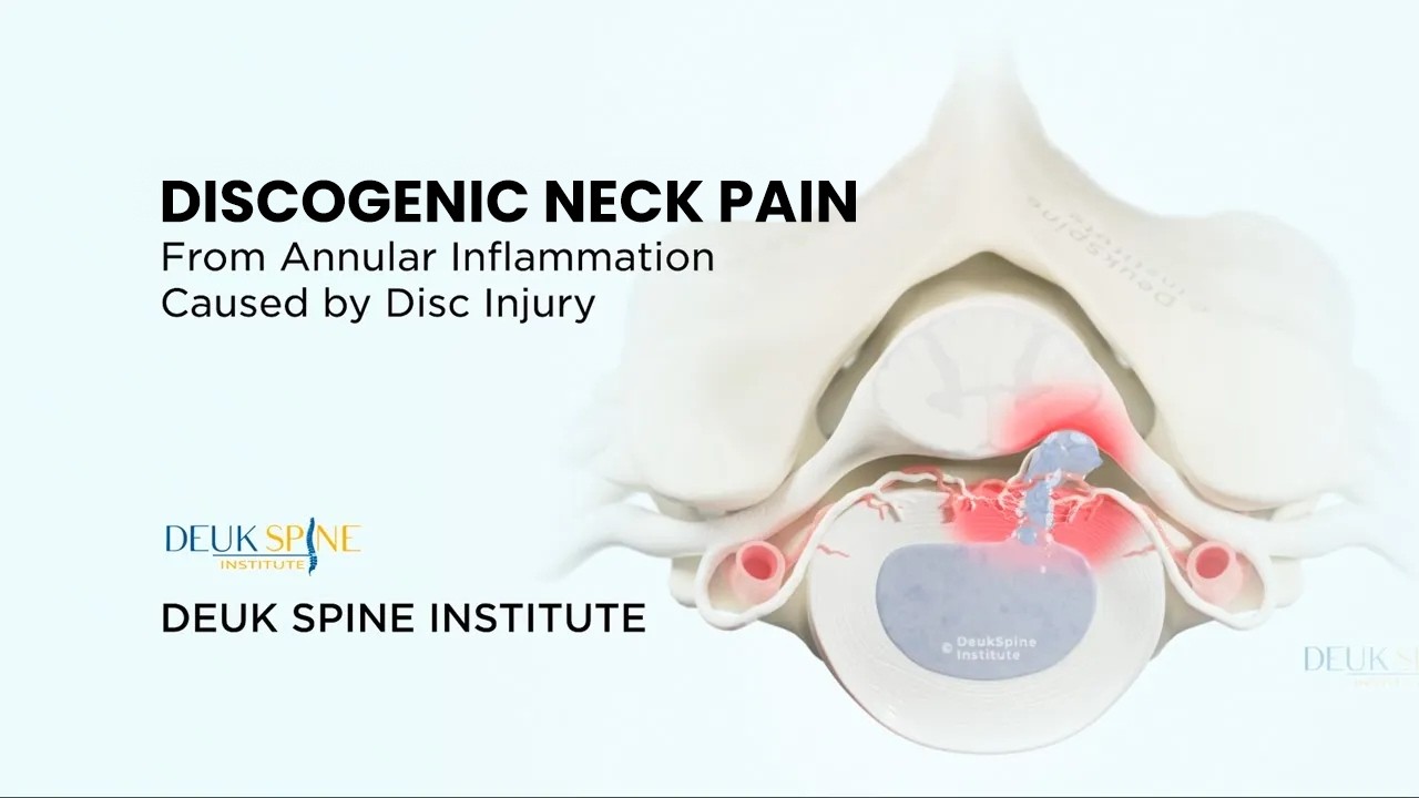 Discogenic Neck Pain - (3D Animation)