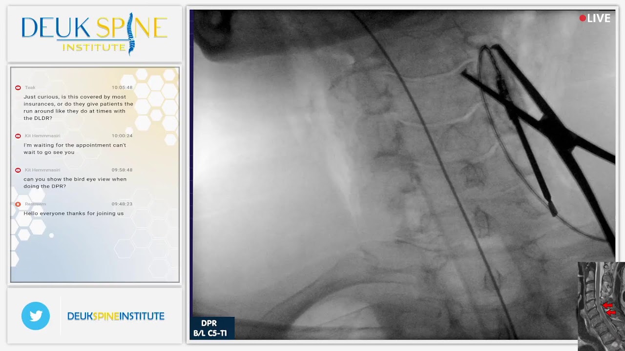 Watch Live Back Treatment! Deuk Plasma Rhizotomy (DPR) B/L C5-T1