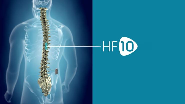 hf10-spinal-cord-stimulator