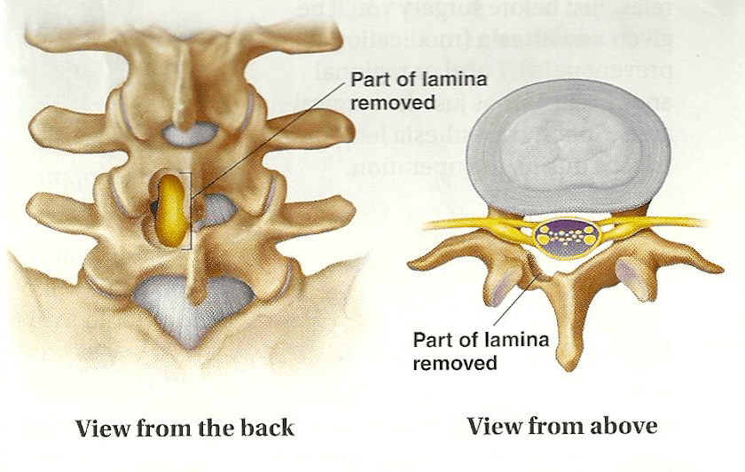 spinal-fusion-surgery-laminectomy