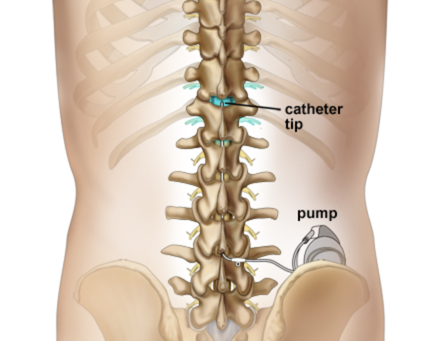 intrathecal-pumps-spine-surgery