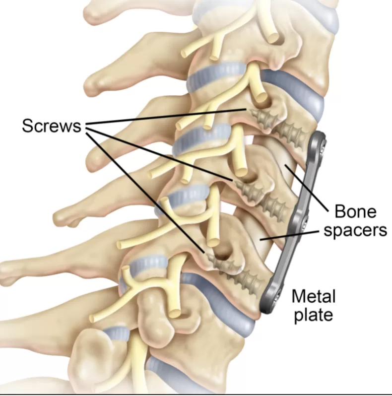 Anterior-Cervical-Discectomy-and-Fusion