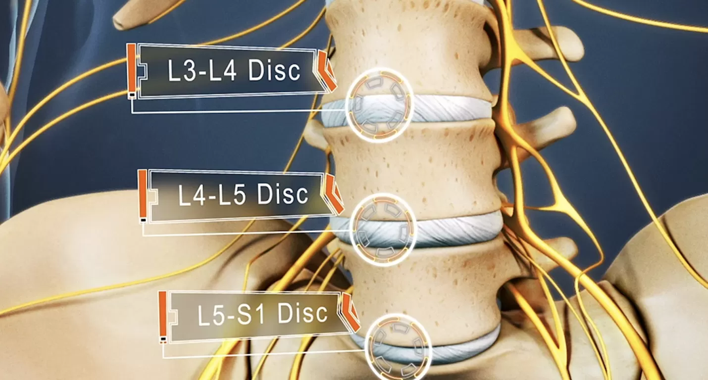 Lumbar-L3-L4-disc-herniation