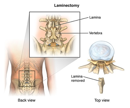 neck-pain-laminectomy