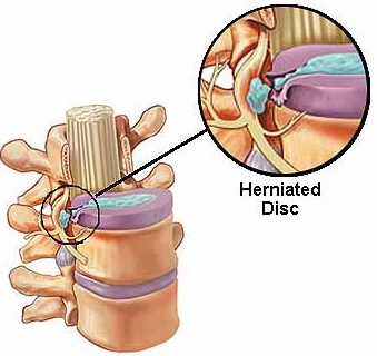 spinal-fusion-surgery-discectomy