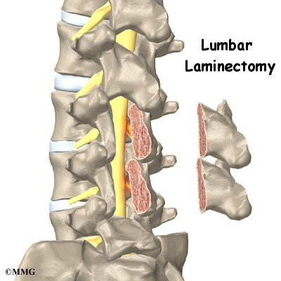 Laminectomy-Surgery