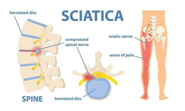 Illustration of how sciatica pain occurs, highlighting a pinched nerve in the spine and the sciatic nerve in the leg.