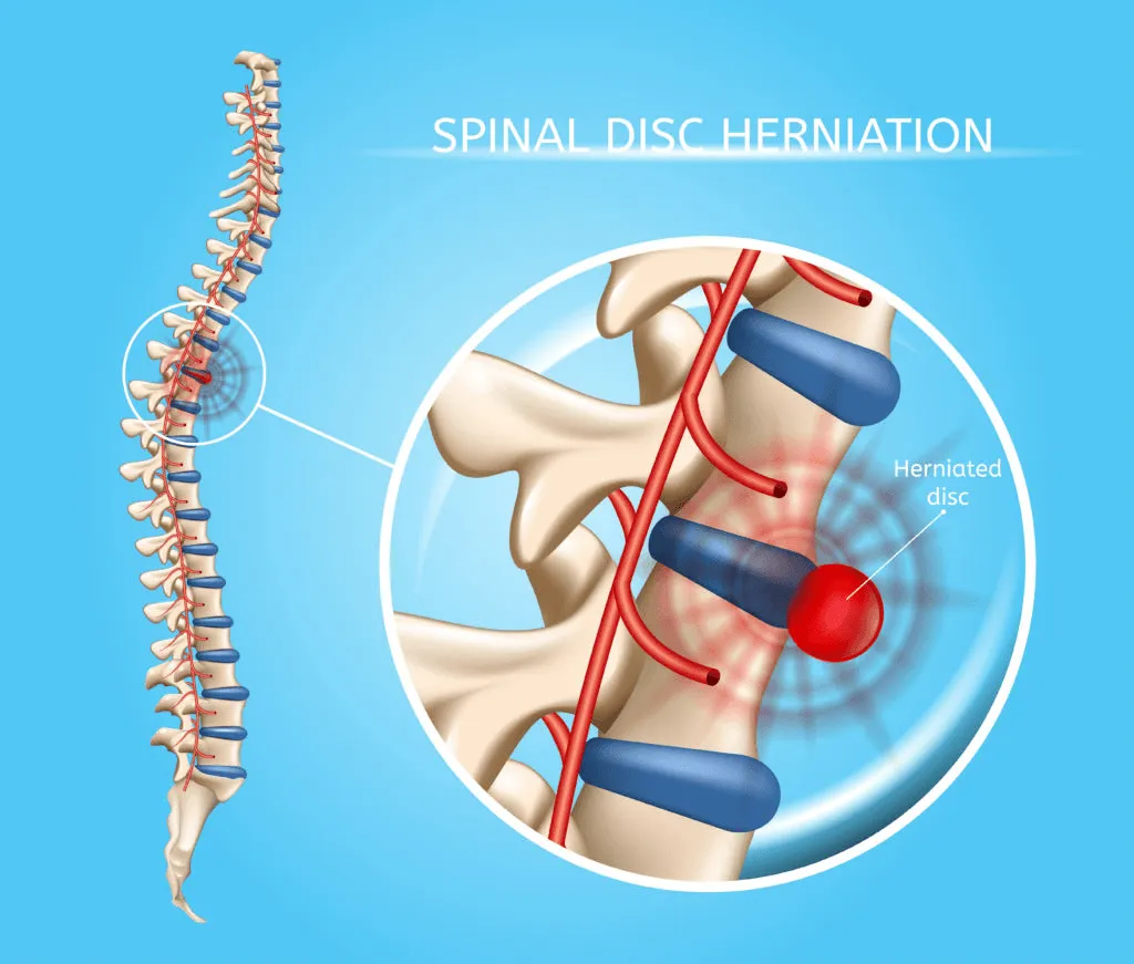 Spinal Disk Harinated.png