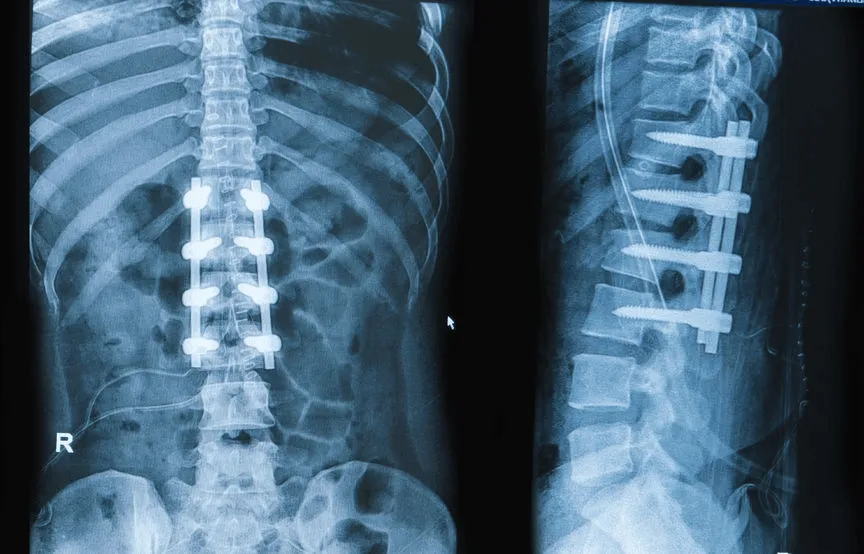 Spinal Fusion Surgery.png