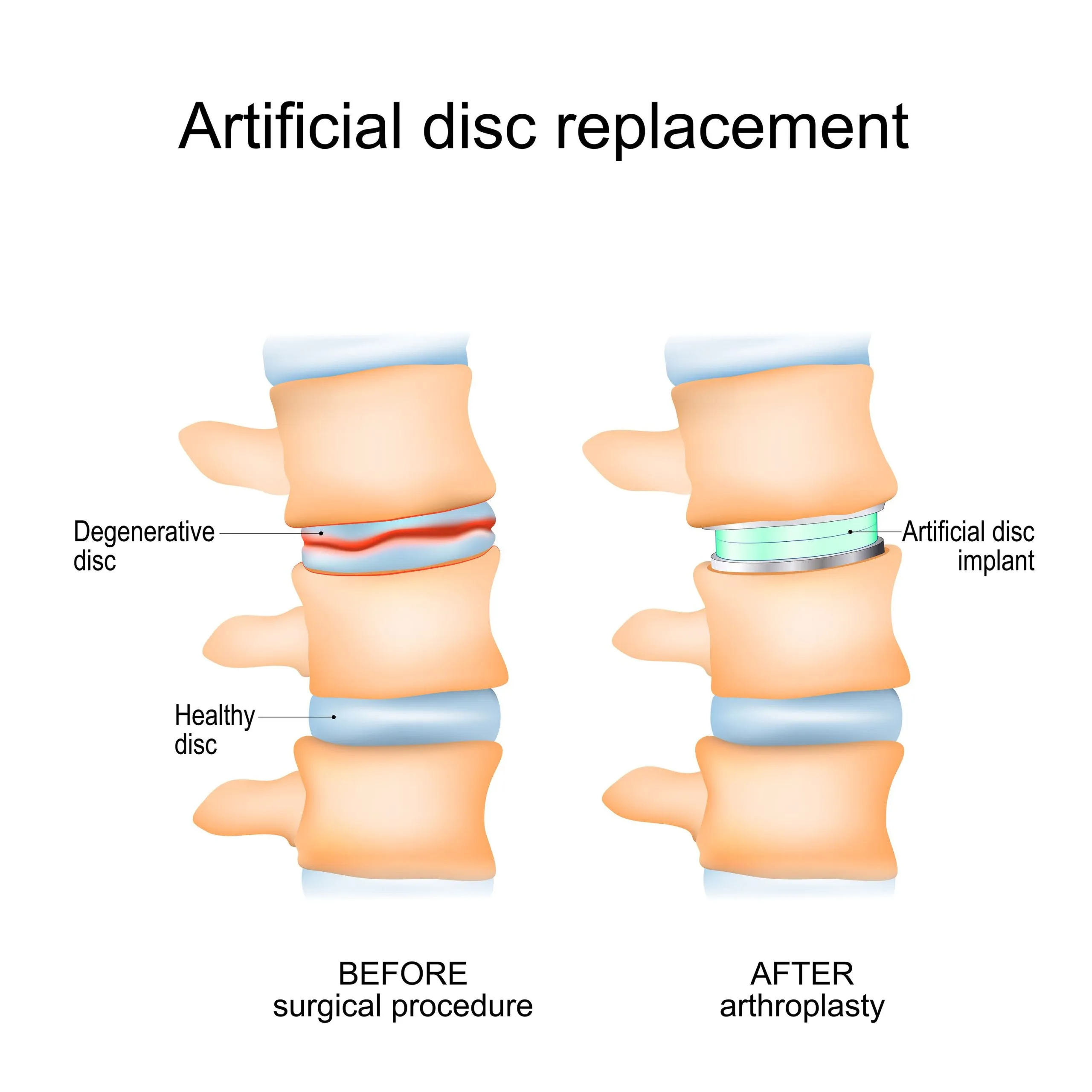 A picture demonstrating spine before and after Artificial Disc Replacement