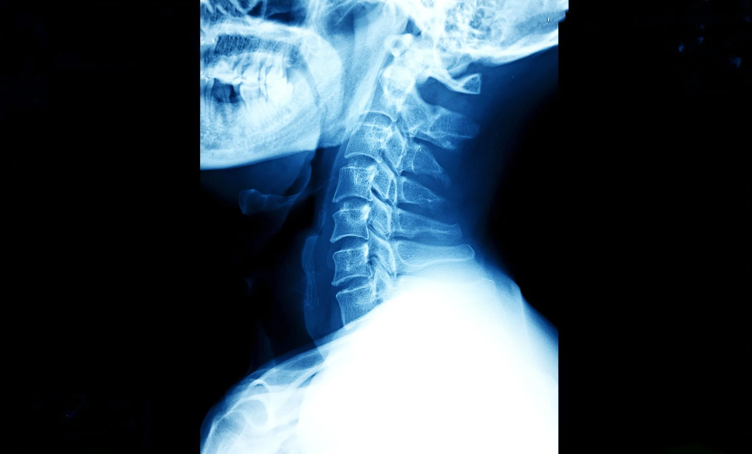 An Xray of person neck or cervical region.