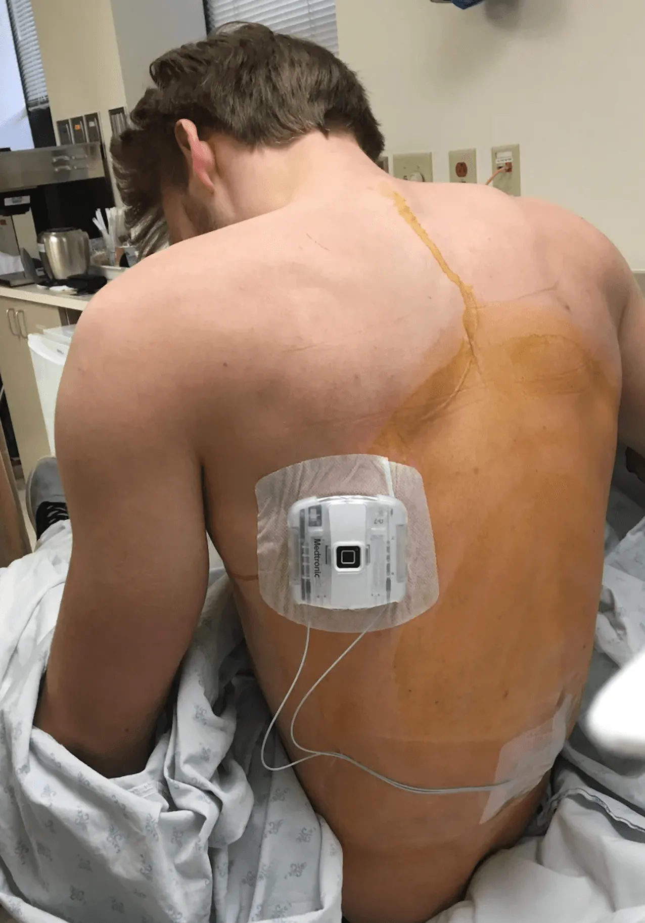 Patient's back with Spinal Cord Stimulator post-surgery, showing device and surgical marks.