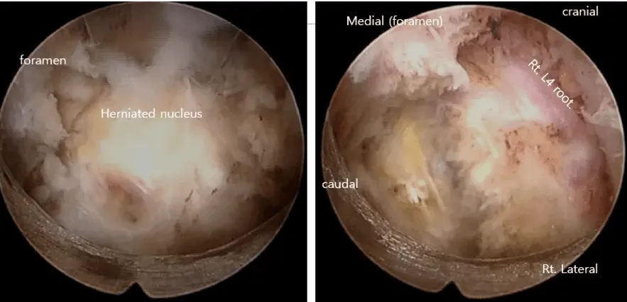 Endoscopic Spine Surgery Performed.png