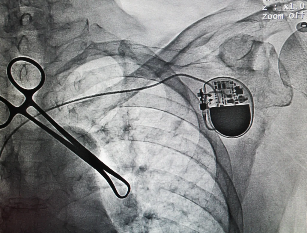 spinal-cord-stimulator.jpg