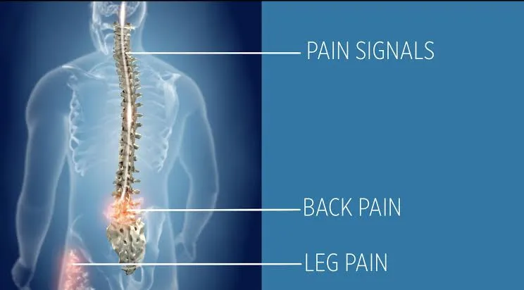 Spinal Cord Stimulator Review.jpeg