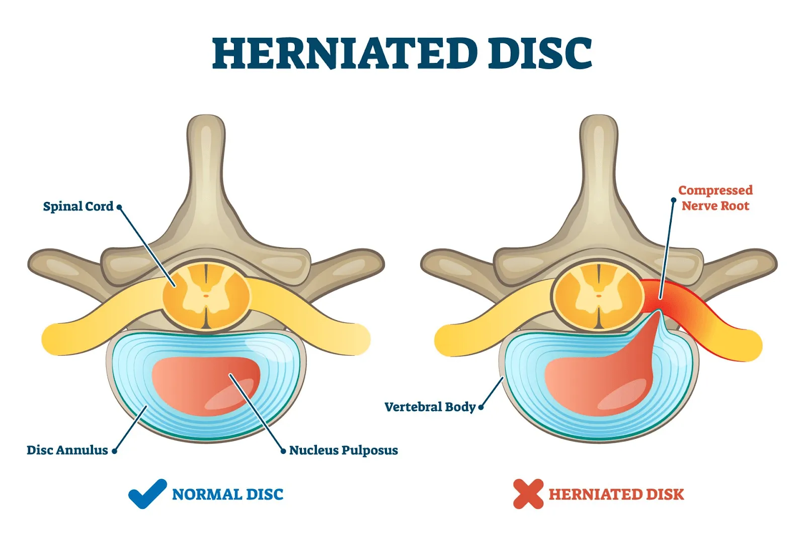 Illustration comparing a normal spinal disc to a herniated disc with labeled parts.
