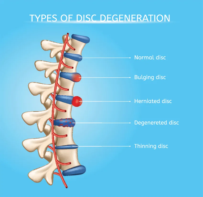 Illustration showing types of spinal disc degeneration with labeled examples.