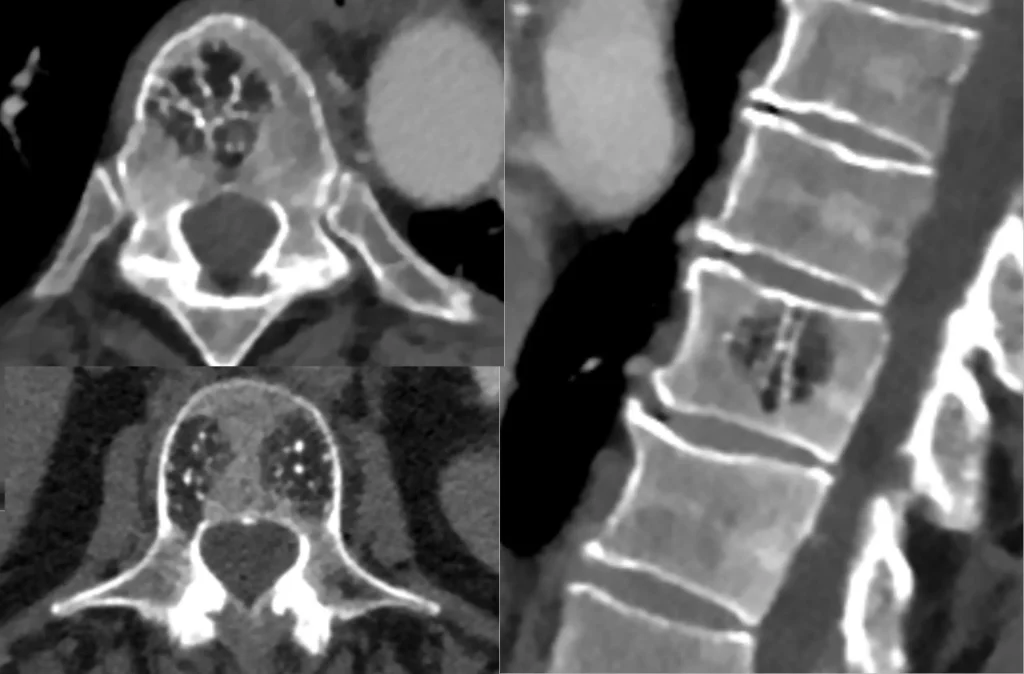 CT scans showcasing Hemangioma Spine