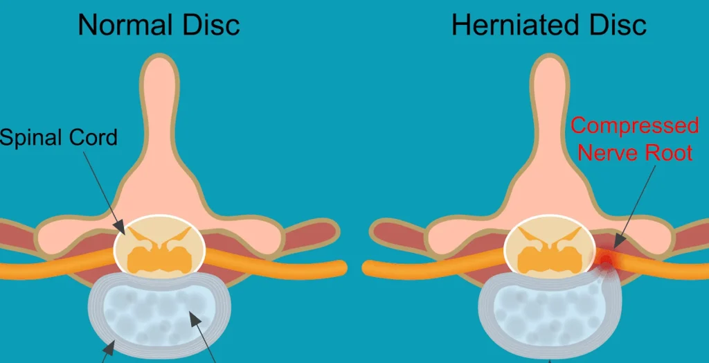 A picture showcasing a comparison between a normal disc and a herniated disc.