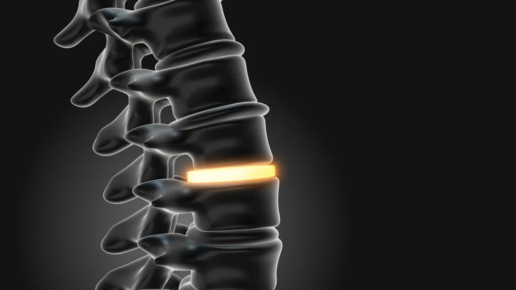 3D model showing a glowing spine disc illustrating Intervertebral Disc Disease.