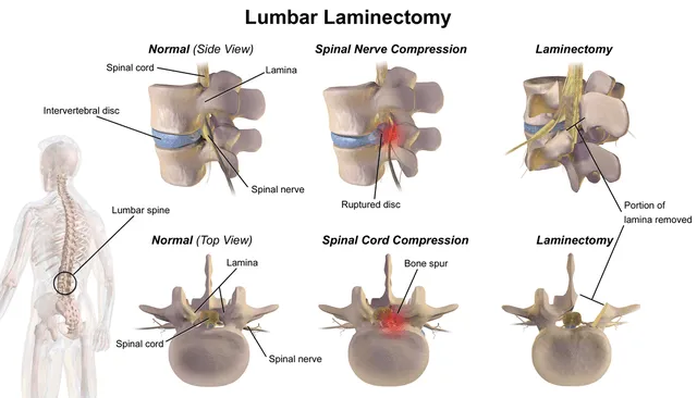 Diagram demonstrating before and after laminectomy procedure.