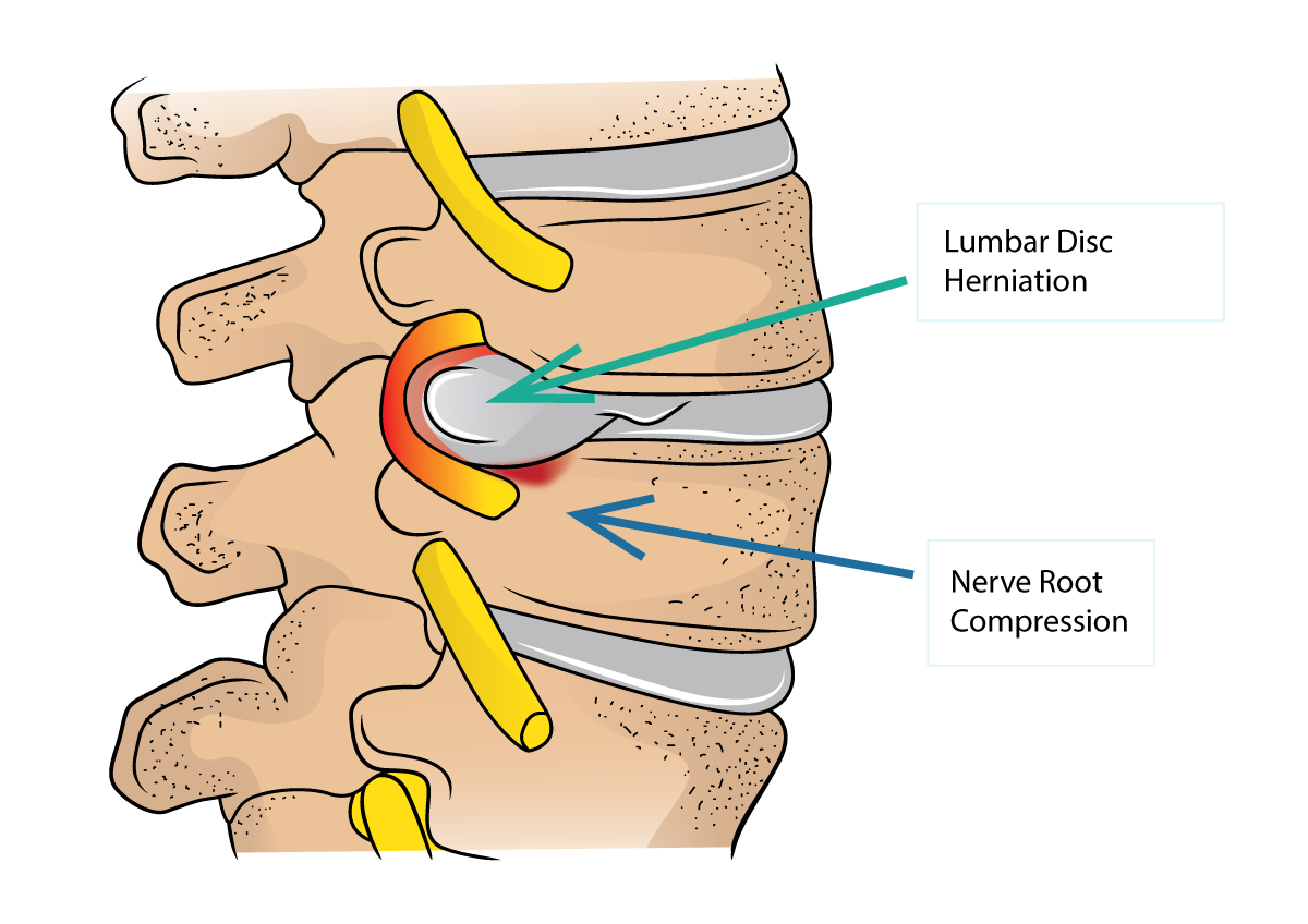 Lumbar Disc Herniation Complete Spine And Pain Care Hot Sex Picture