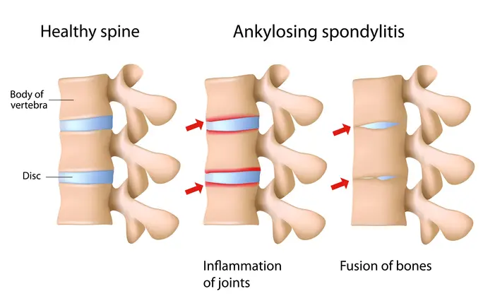 Spine Arthritis.webp