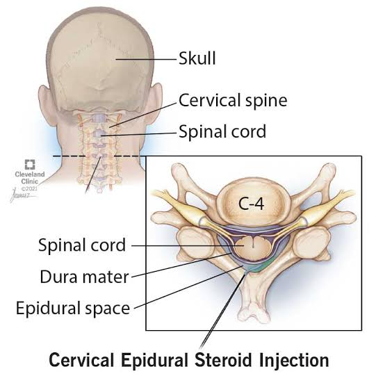 epidural-steroid-injections