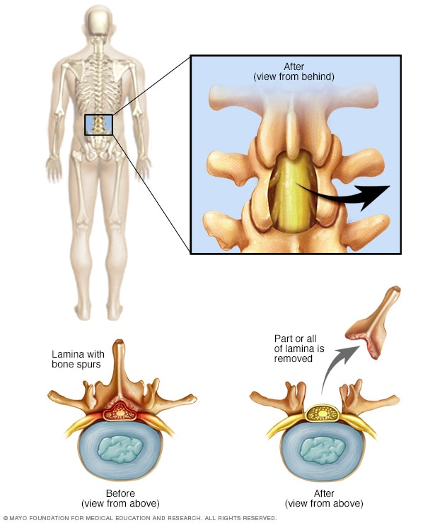 spinal-fusion-alternatives-laminectomy