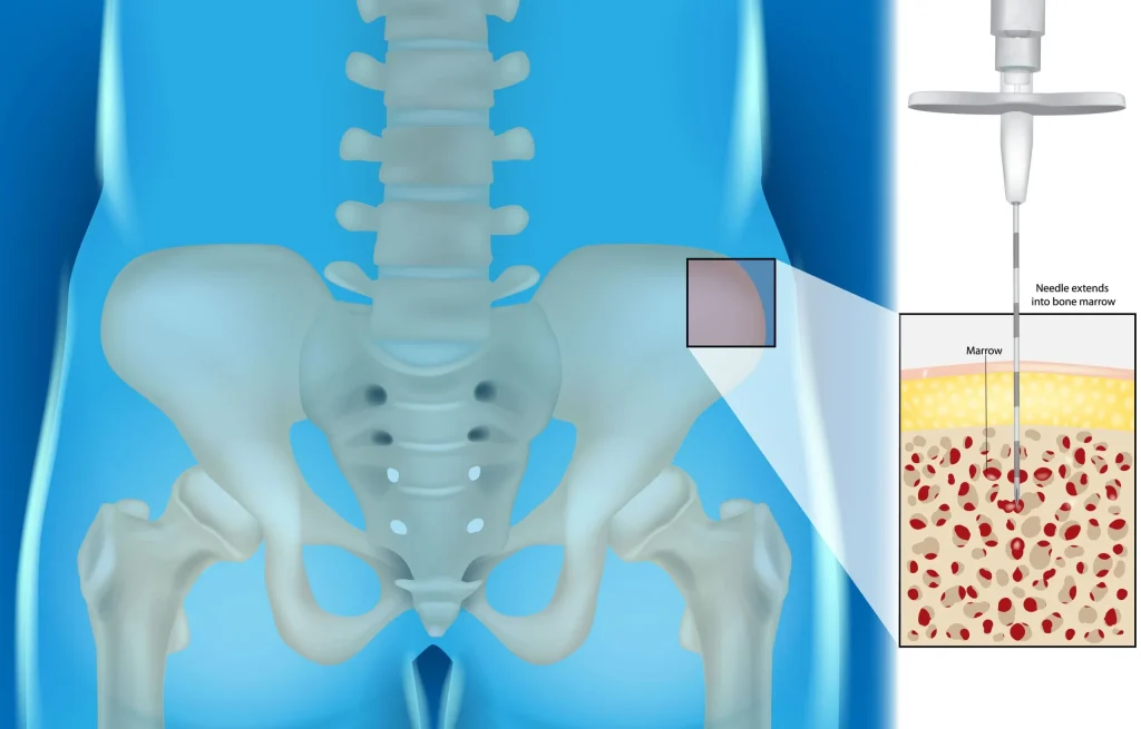 Graphic of BMAC therapy, a regenerative treatment for healing and pain management..