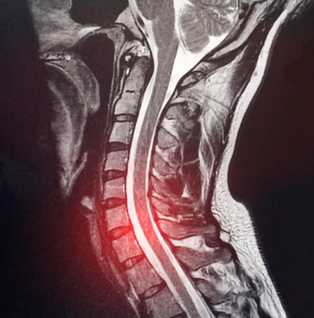 C6-C7 Disc Herniation MRI Showing Cervical Spine Compression