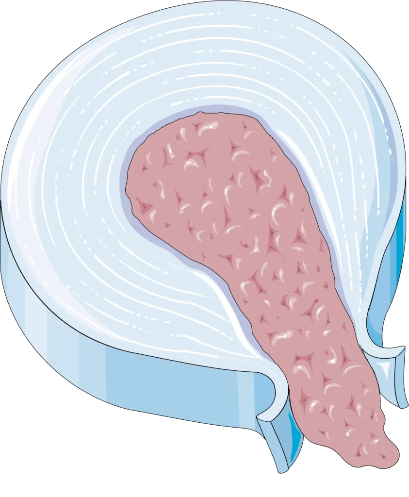 Illustration of a disc extrusion in the spine, showing protruding inner material.