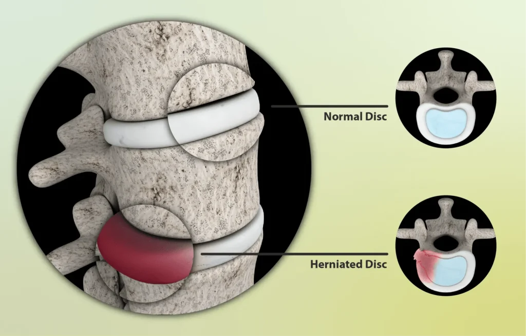 An animation showing both normal and the herniated disc.