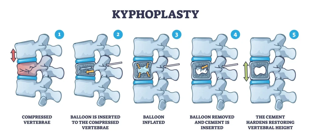 Illustration of kyphoplasty, a spinal fracture treatment through steps 1-5.