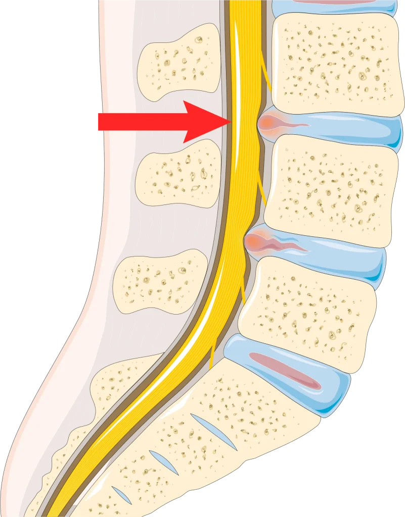 Diagram showing L3-L4 disc herniation pressing on spinal nerve.