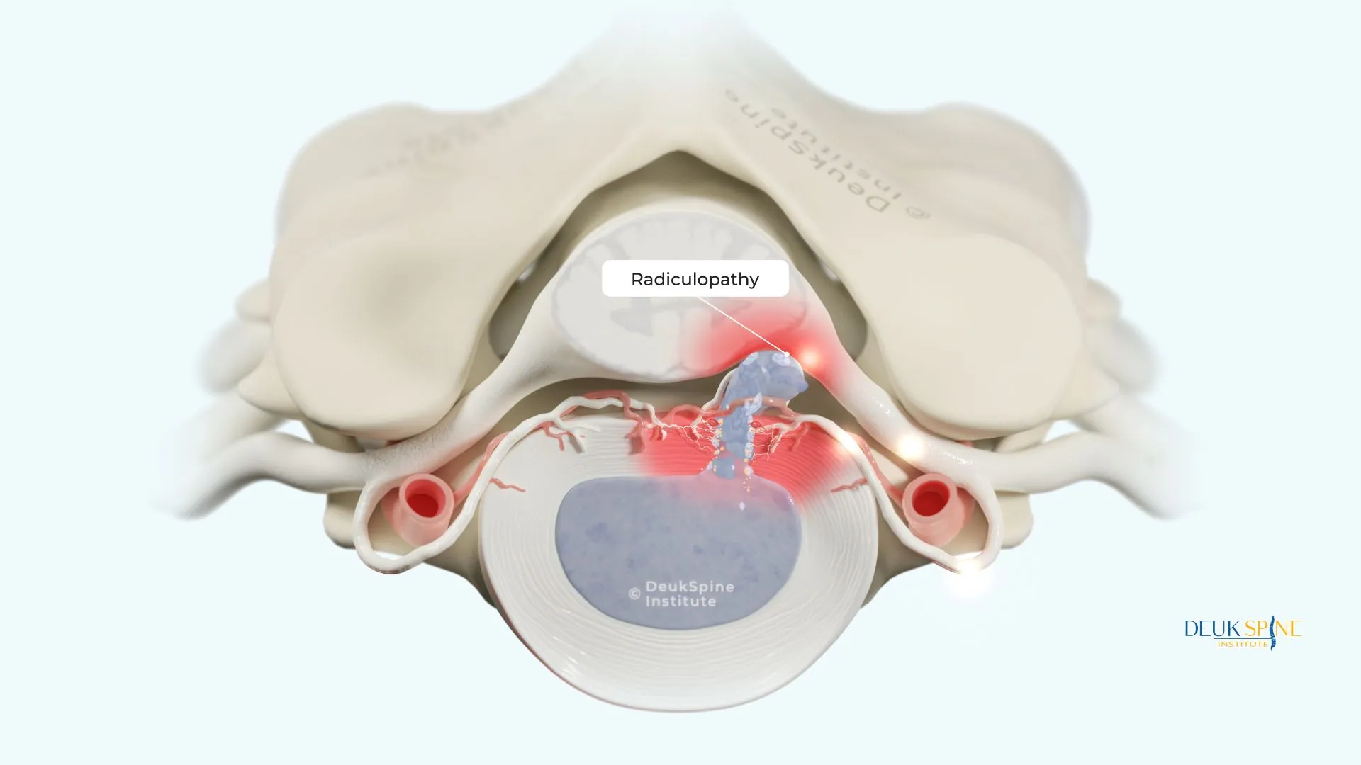 Illustration of radiculopathy in a spinal section with labels, from Deuk Spine Institute.