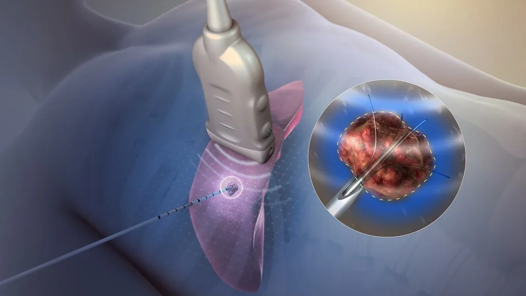 Illustration of a medical device targeting a tumor for pain management therapy.