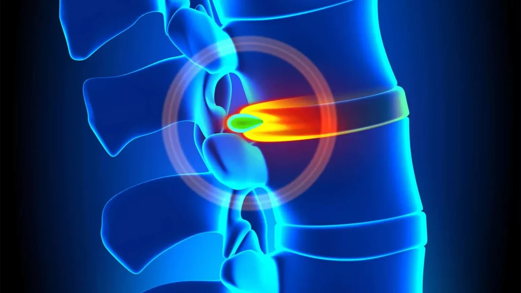 Digital illustration of a human spine with a highlighted ruptured disc in orange.