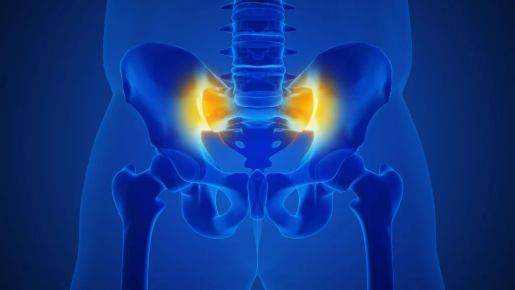 Illustration highlighting sacroiliitis