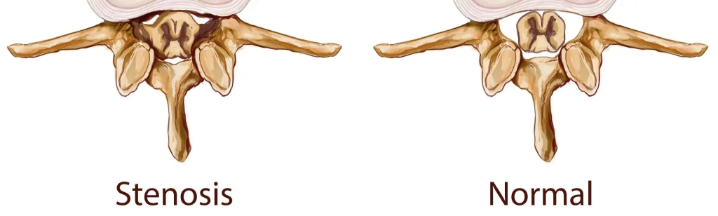 Comparison between a normal spine vs spine with stenosis.