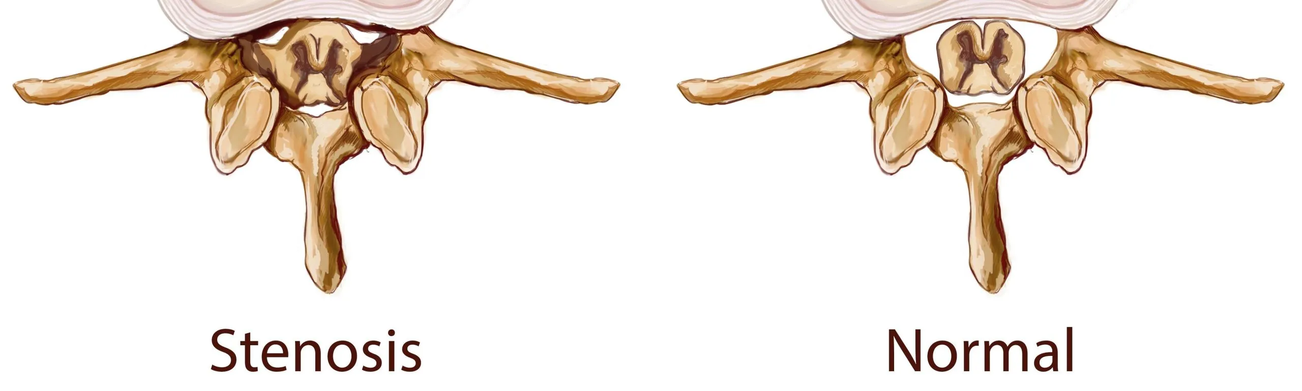 Comparison between a normal spine vs spine with stenosis.