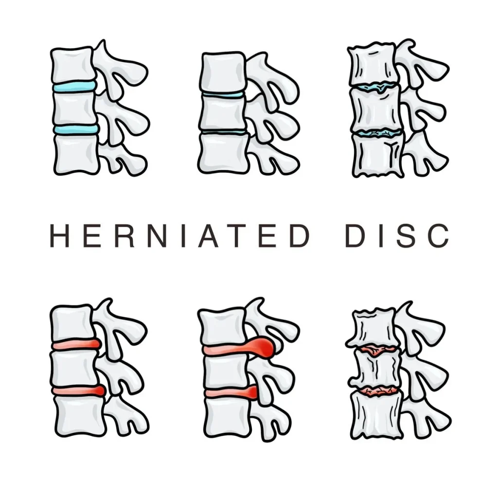 herniated disc