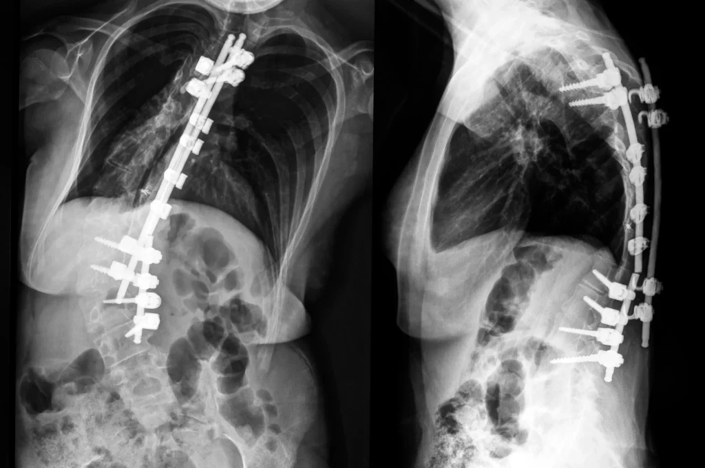 X-ray images showing spinal fusion with metal rods and screws in the spine.