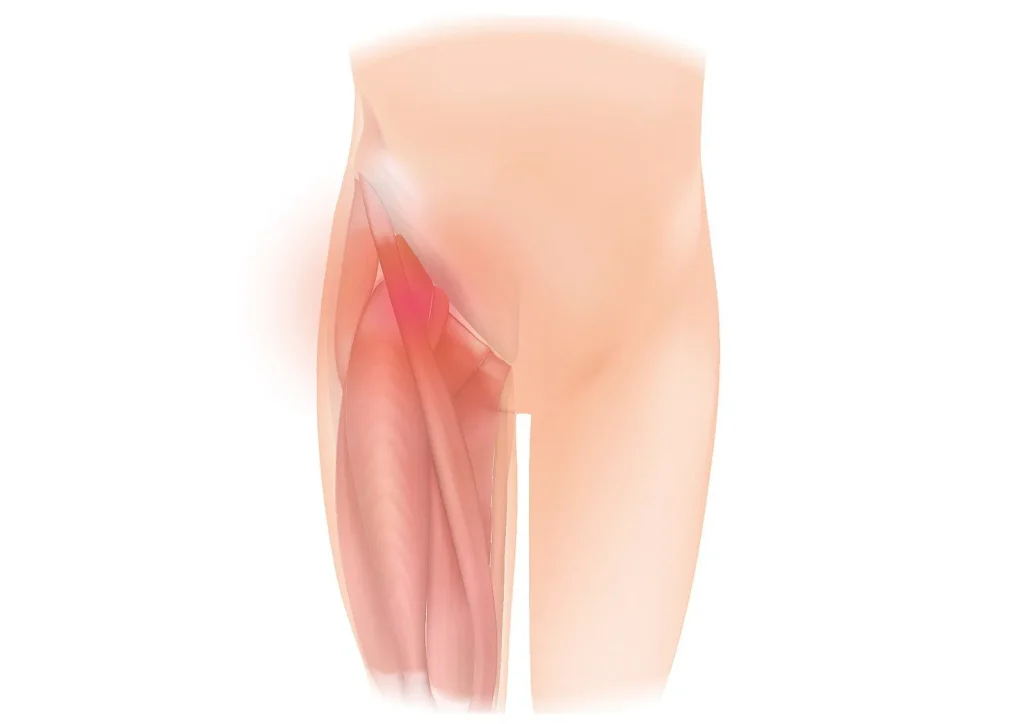 Illustration of herniated disc affecting hip and leg muscles, highlighting nerve compression.
