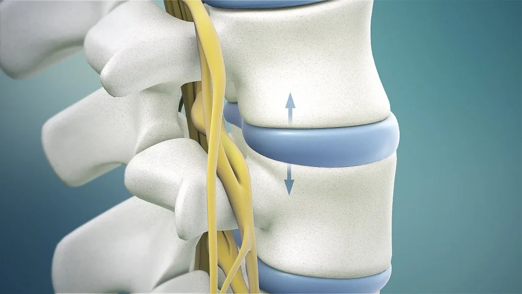 Illustration of a herniated disc between vertebrae compressing a nerve.