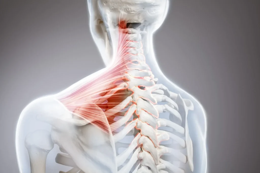 Illustration of a herniated disc in the cervical spine, highlighting affected muscles and vertebrae.