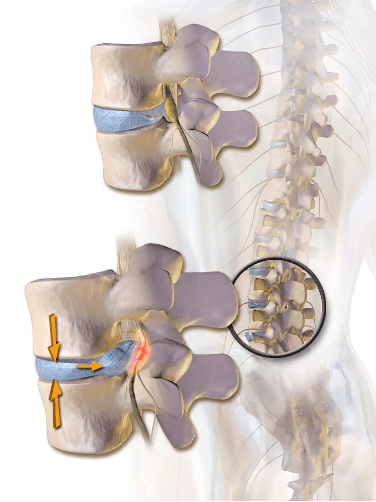Disc herniation drawn image.