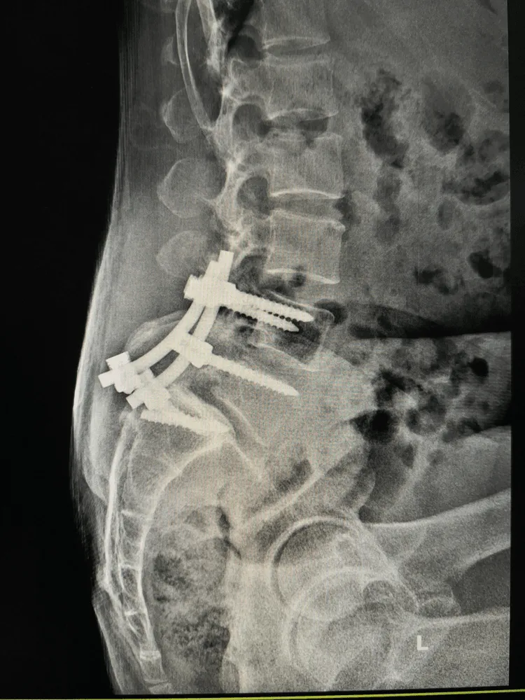 Example of metal hardware placed in body during spinal fusion