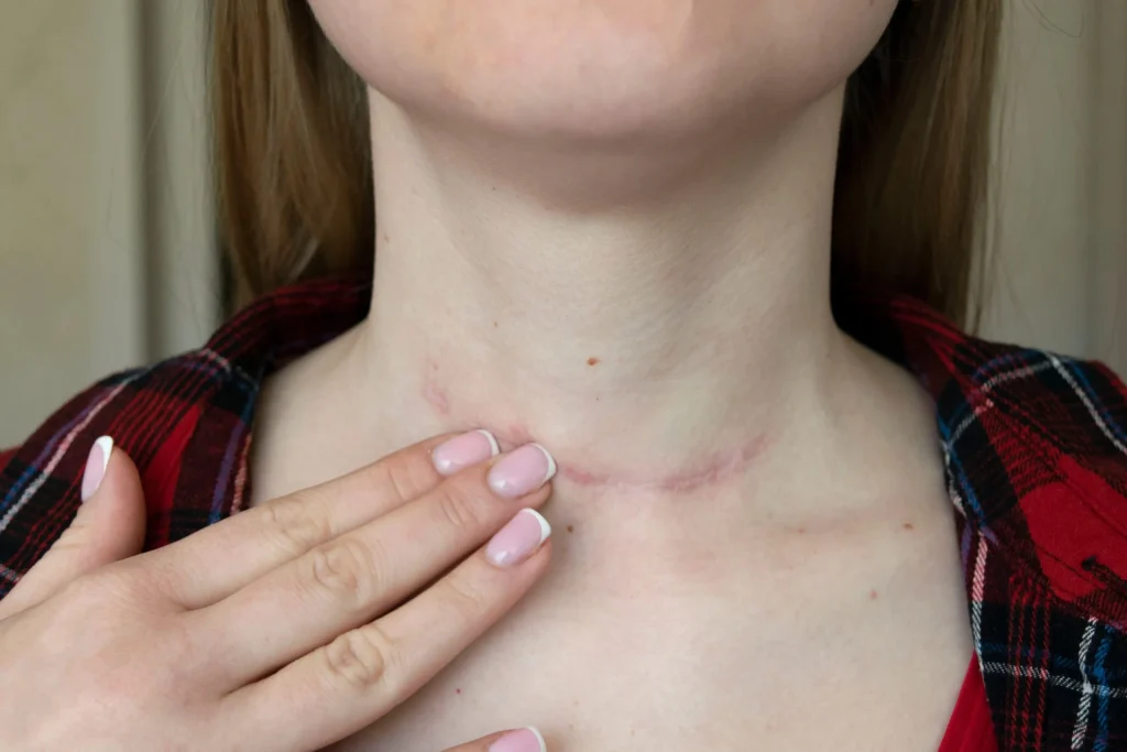 A person shows a healing scar on their neck from anterior cervical corpectomy surgery.